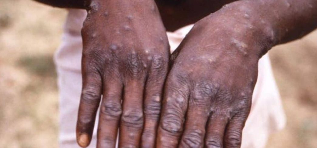 Akwa Ibom Records 5 Cases of Monkeypox